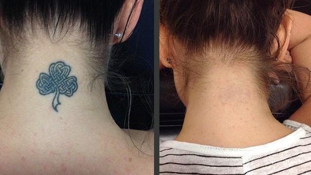 Permanent Tattoo Removal Cream