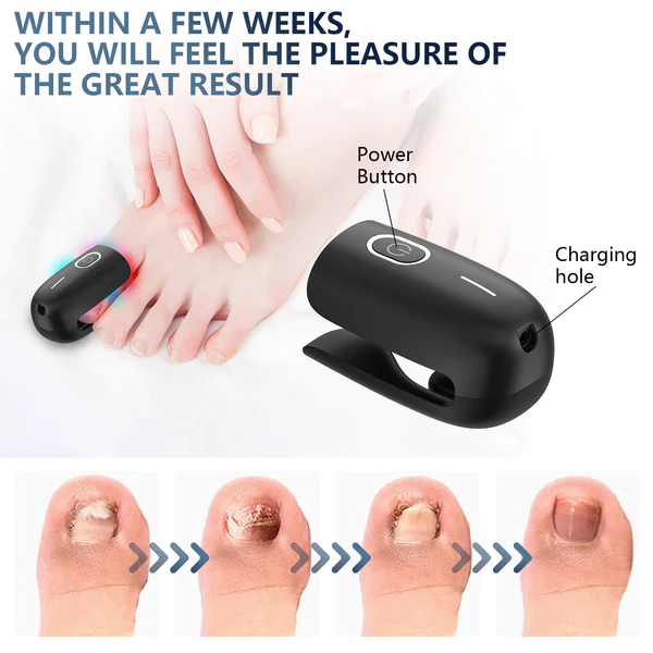 Fivfivgo™ Dispositif laser antifongique