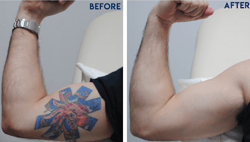 Permanent Tattoo Removal Cream