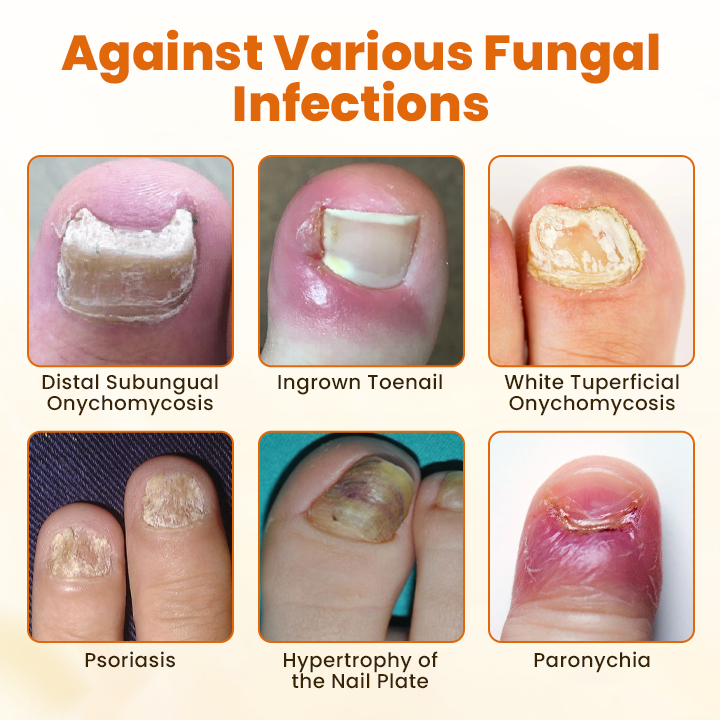 Cvreoz® FungiFix Bee Venom Nail Spray