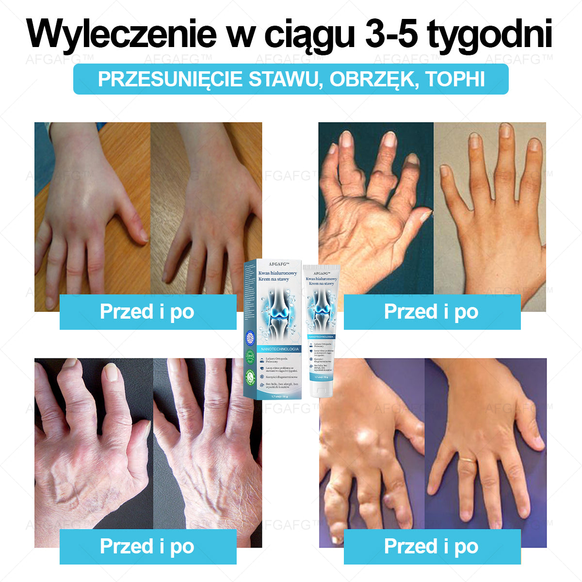 AFGAFG™ 𝐇𝐲𝐚𝐥𝐮𝐫𝐨𝐧𝐢𝐜 𝐀𝐜𝐢𝐝 𝐉𝐨𝐢𝐧𝐭 𝐑𝐞𝐩𝐚𝐢𝐫 𝐂𝐫𝐞𝐚𝐦👩‍⚕️（𝐓𝐡𝐨𝐫𝐨𝐮𝐠𝐡 𝐭𝐫𝐞𝐚𝐭𝐦𝐞𝐧𝐭  𝐨𝐟 AFGAFG™, 𝐧𝐞𝐮𝐫𝐚𝐥𝐠𝐢𝐚, 𝐦𝐮𝐬𝐜𝐥𝐞 𝐩𝐚𝐢𝐧𝐬）