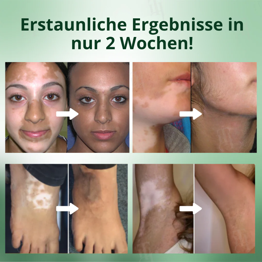 Fivfivgo® Vitiligo Behandlung Creme