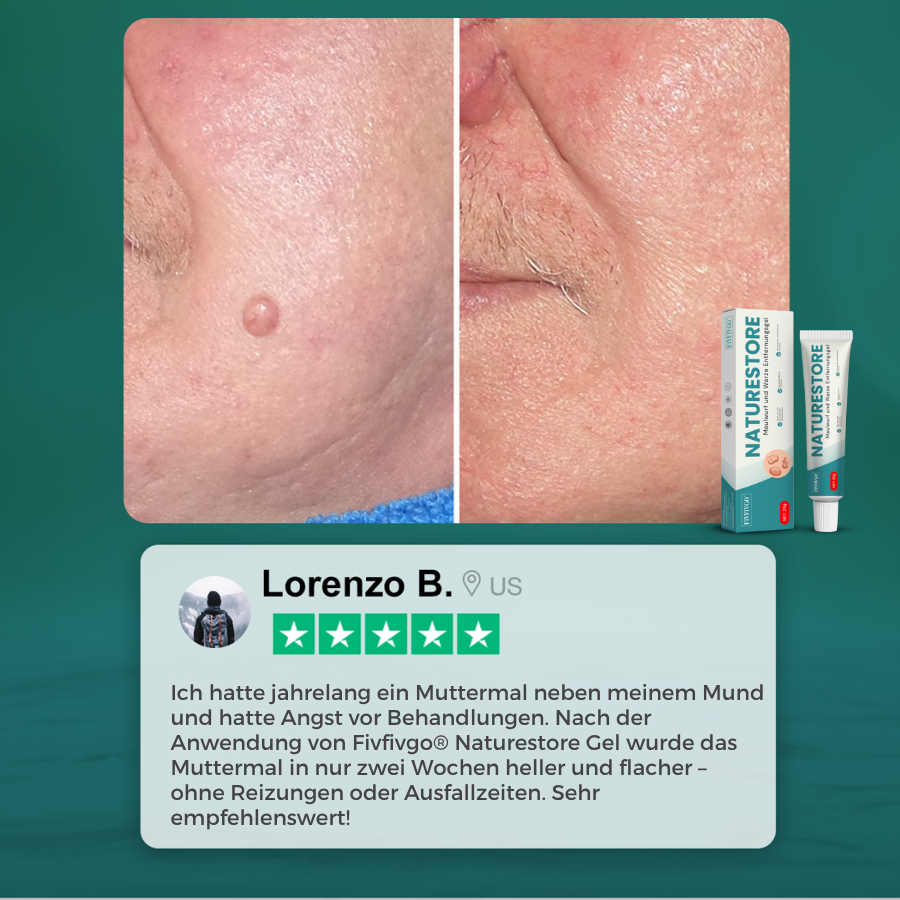 Fivfivgo® NatureStore Maulwurf und Warze Entfernungsgel