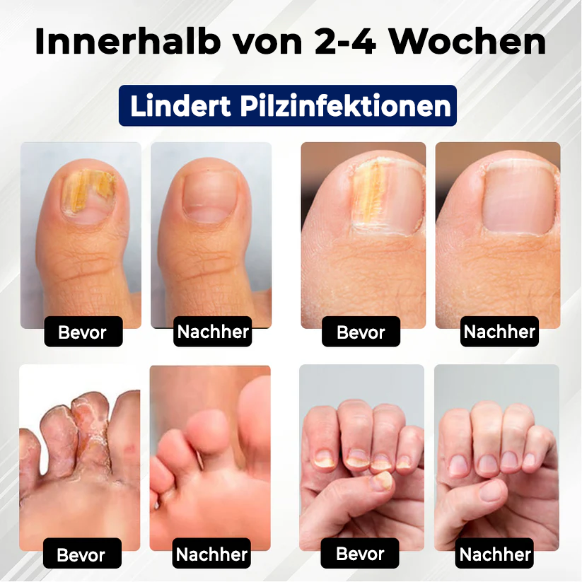 Fivfivgo® Fungiclear Bienen Therapie Nagelspray