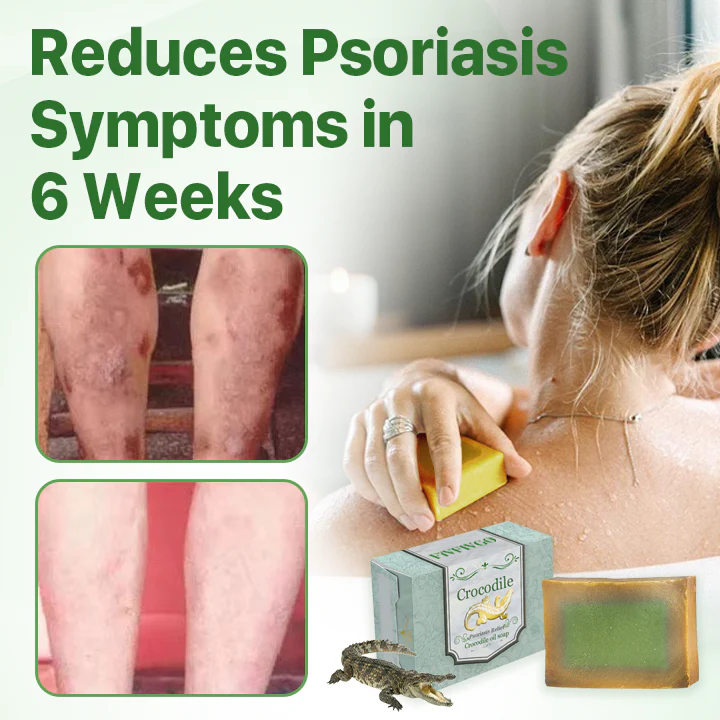 Fivfivgo™ Psoriasis Relief Crocodile Oil Soap