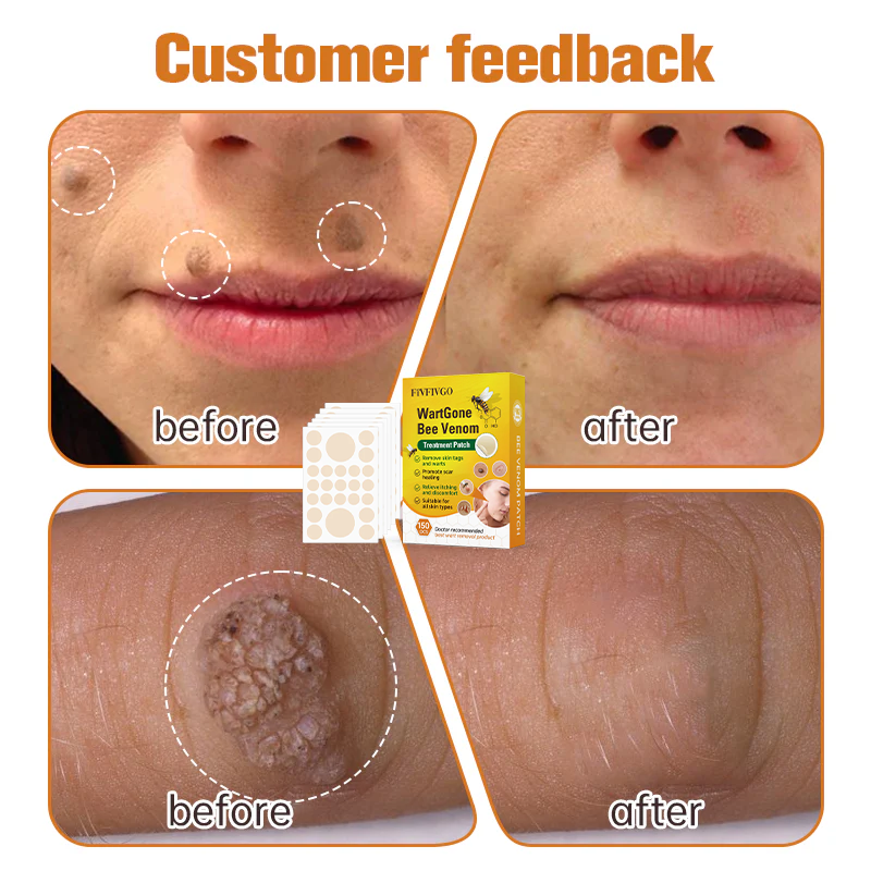 Fivfivgo™ WartGone Bienengift-Behandlung Patch