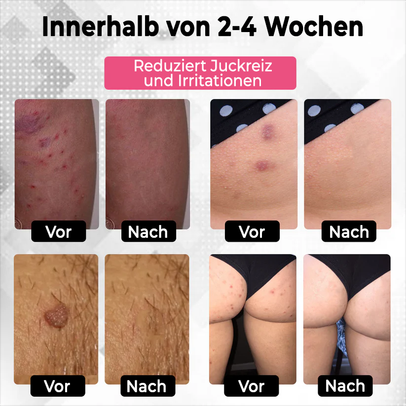 Fivfivgo® Genitalien der Frau HPV-Heilcreme
