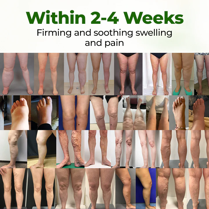 NovaRX® FluidEase Leg Therapy Edema Cream