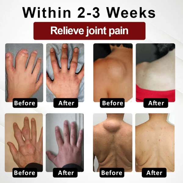 Fivfivgo™ Rosskastanie Arthritis-Massagecreme