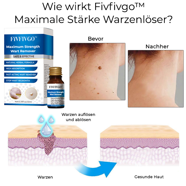 Fivfivgo™ Maximale Stärke Warzenlöser