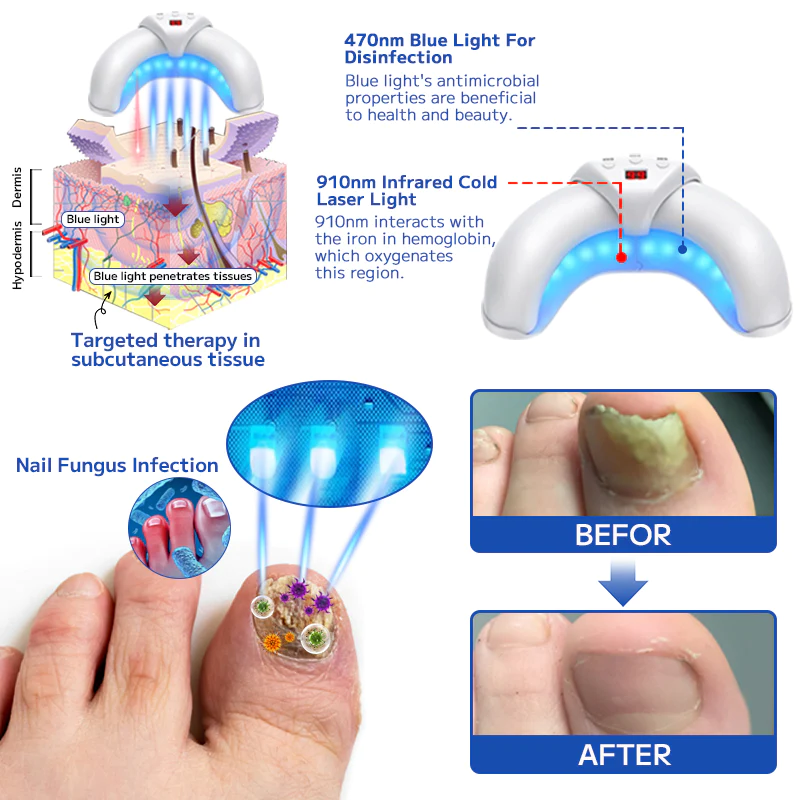 Fivfivgo™ Fungal Nail Treatment Laser Device