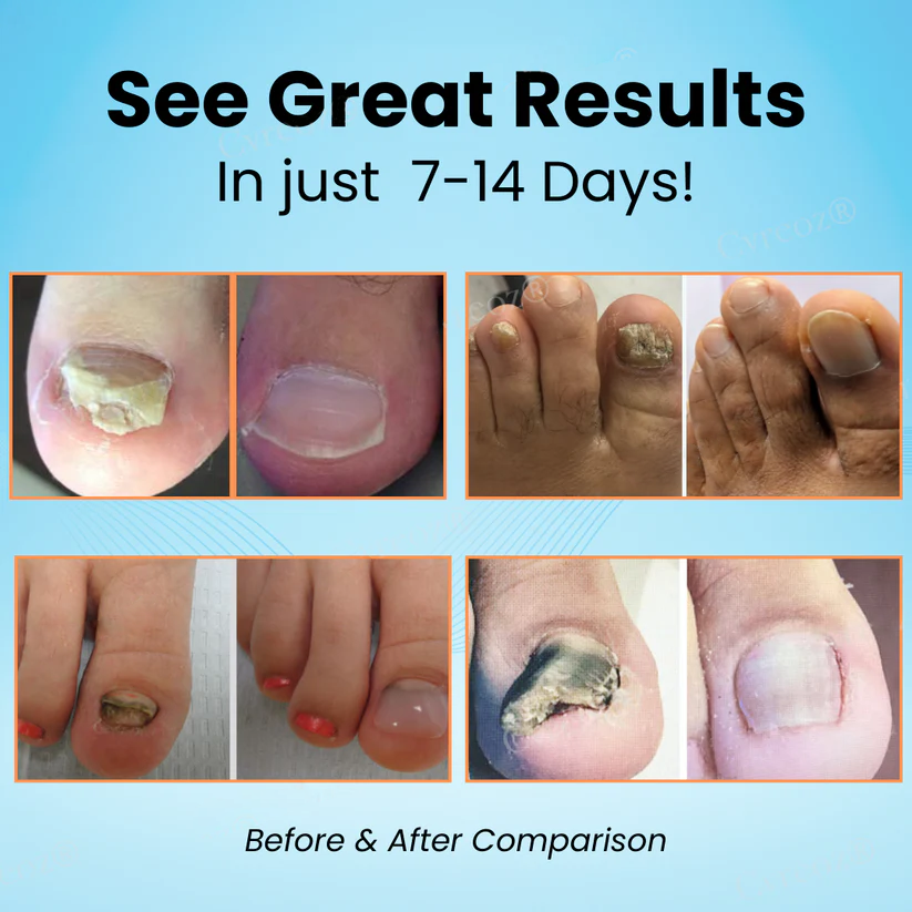 Cvreoz® Nail Strengthening Ointment