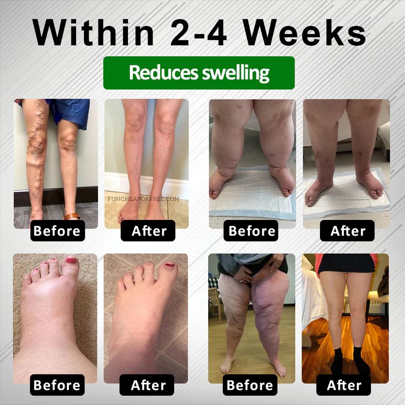 NovaRX® PuffyGone Horse Chestnut Edema Cream