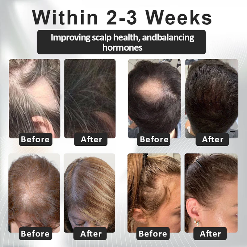 Fivfivgo™ Alopecia Recovery Hair Booster Roll-On