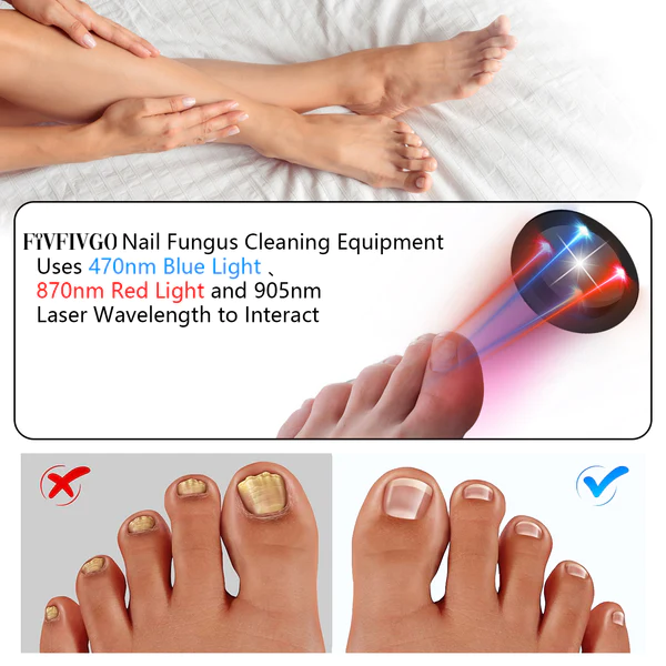 Fivfivgo™ Antifungal Laser Device