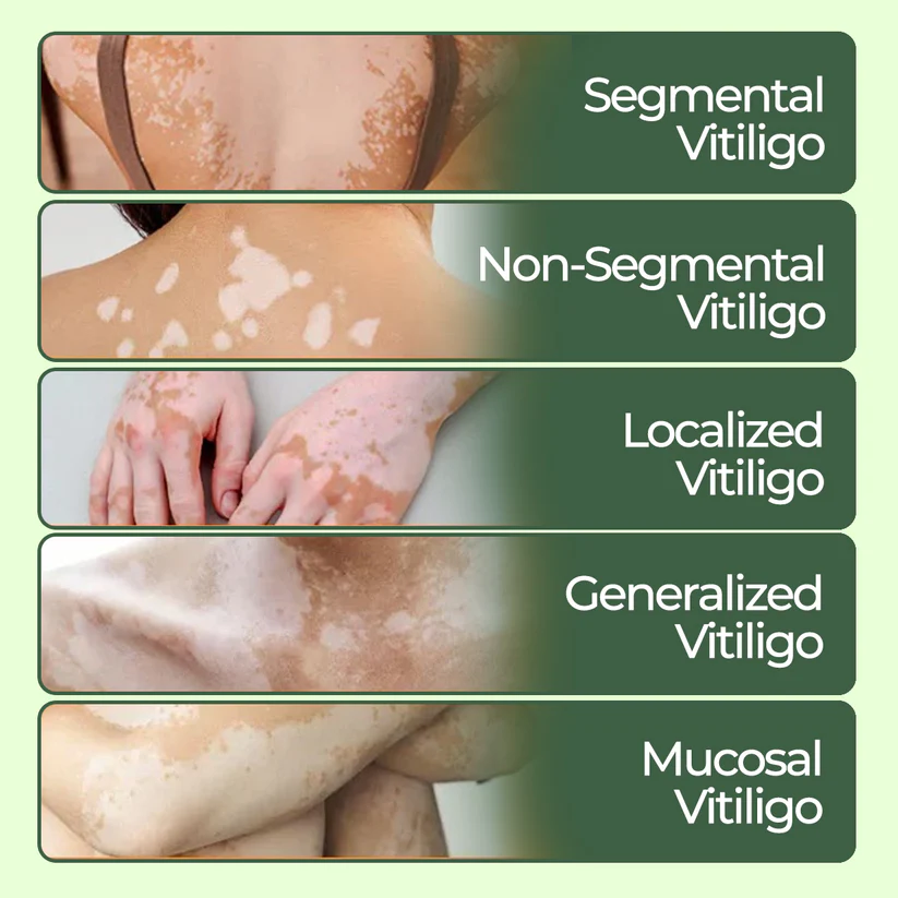Fivfivgo® Vitiligo Treatment Ointment