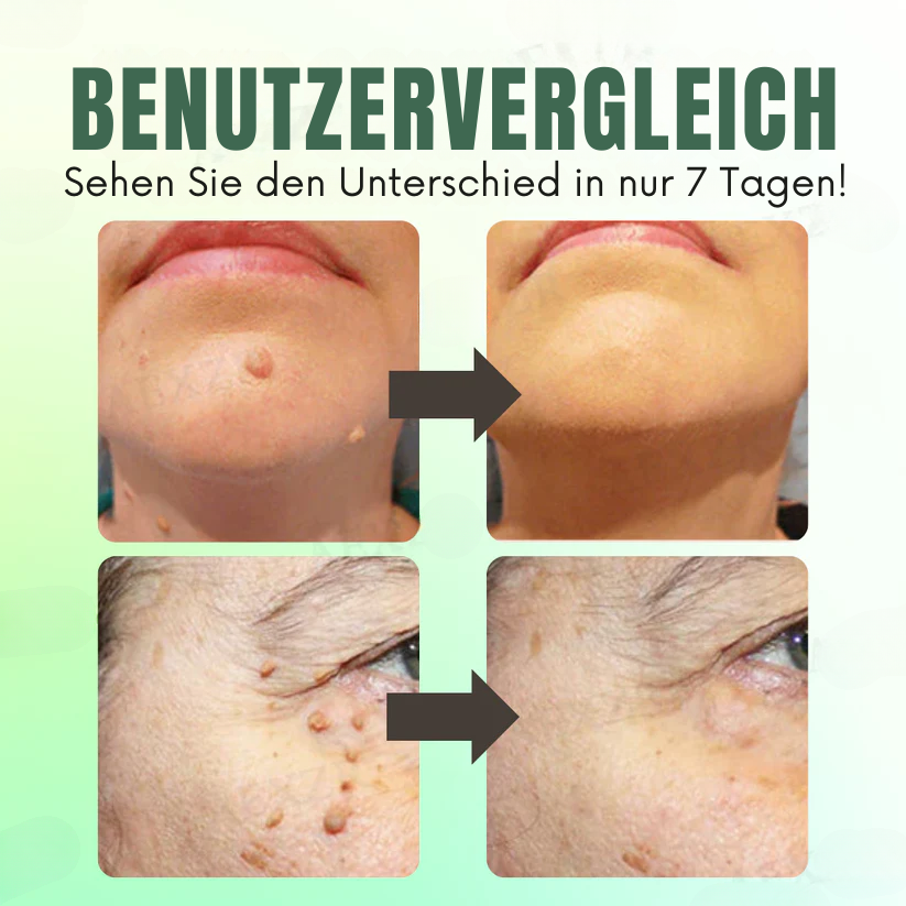 Fivfivgo™ Sofortige Entfernung von Hautunreinheiten