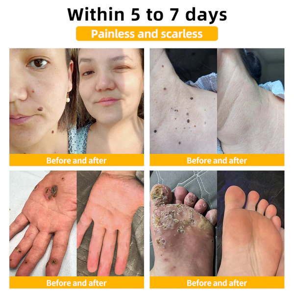 Fivfivgo™ Bee Venom Mole and Wart Cream