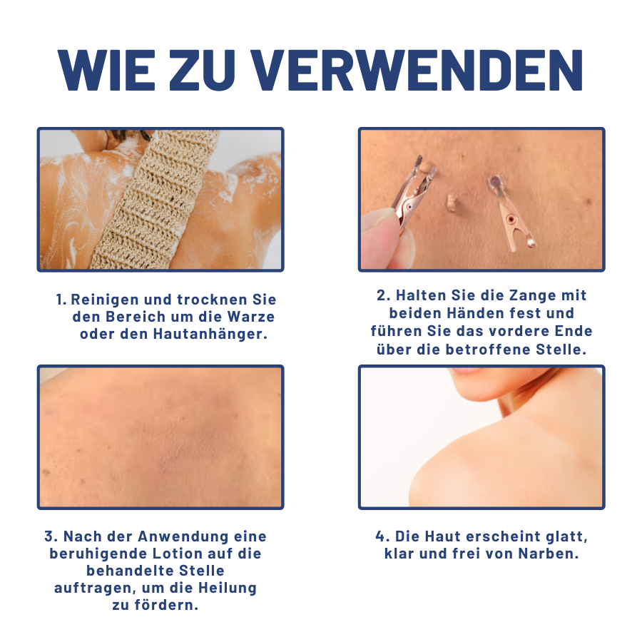 Fivfivgo™ Maulwurfsentfernung Keimfreie Zange