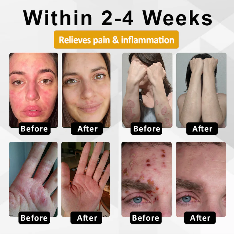 Fivfivgo® NervoRelief Shingles Healing Ointment