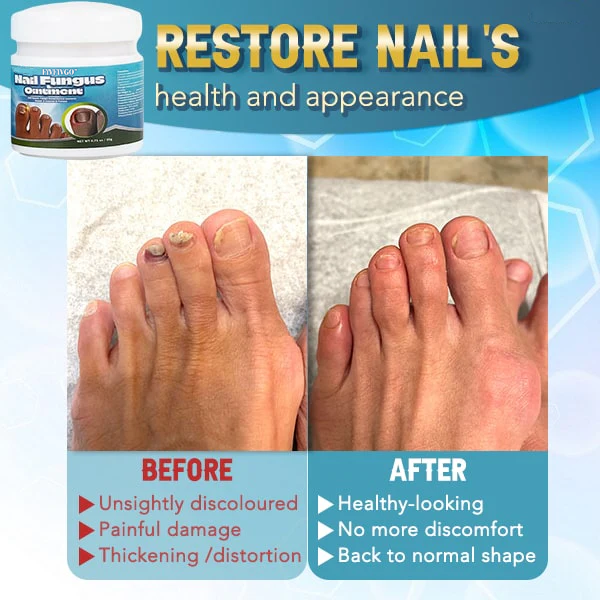 Fivfivgo™ 5X Schnellheilende Nagelpilzsalbe
