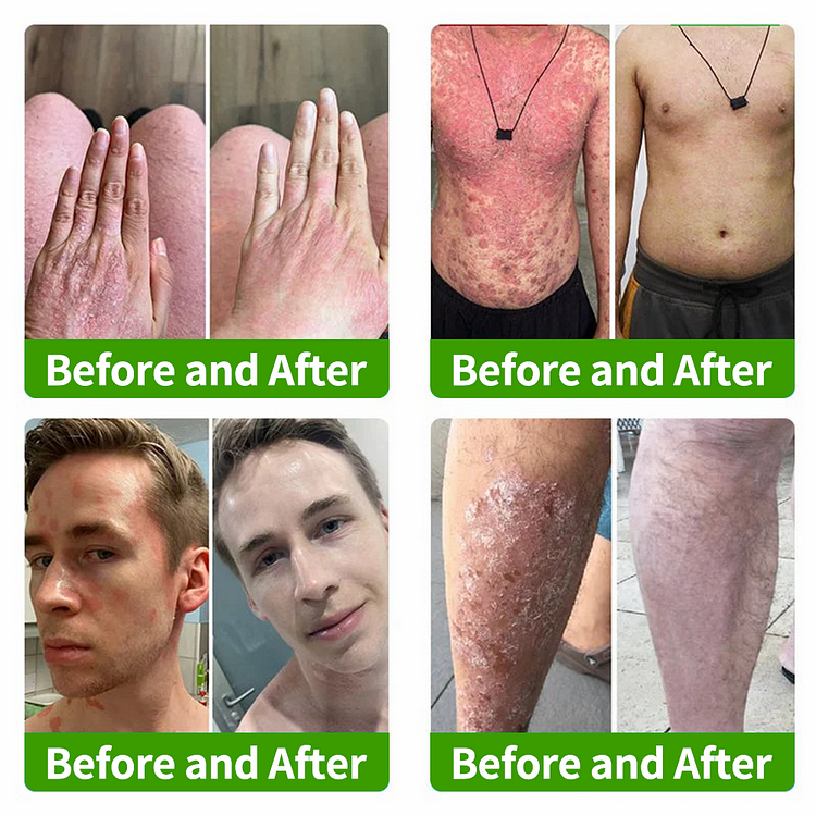 Fivfivgo™ BeeVenom FungiVanish Behandlungsspray