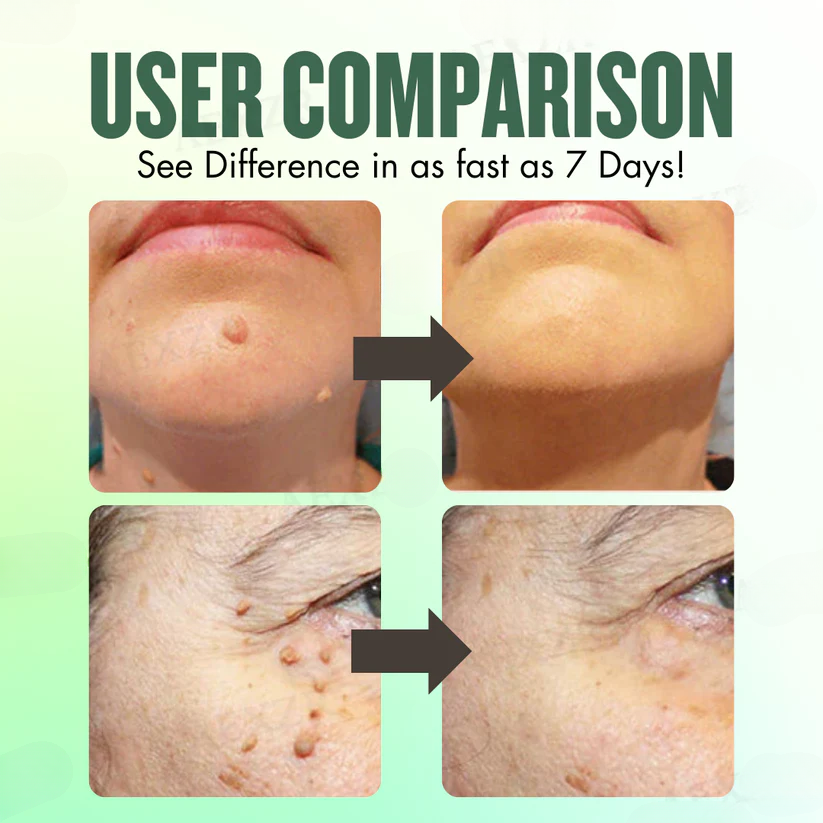 Fivfivgo™ Instant Blemish Removal Cream
