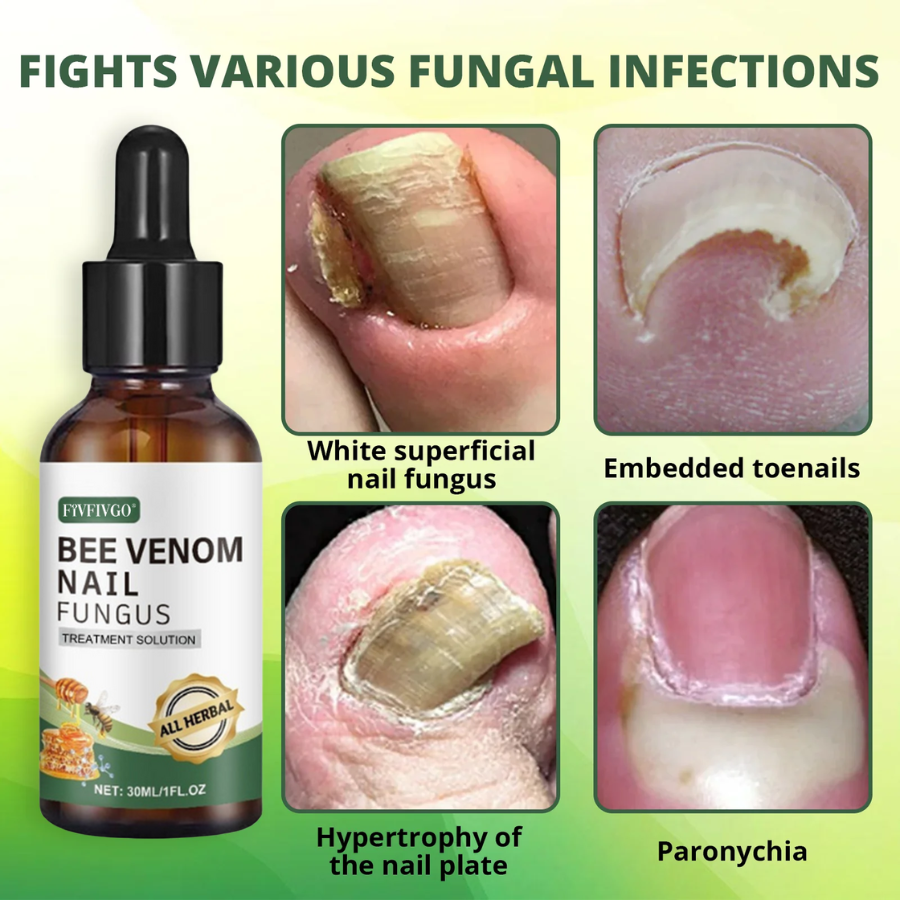 Fivfivgo® Bee Venom Nail Fungus Treatment Solution: Natural Formula for Toenail & Fingernail Health