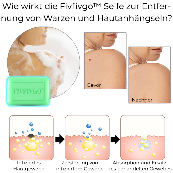 Fivfivgo™ Seife zur Entfernung von Warzen und Hautanhängseln