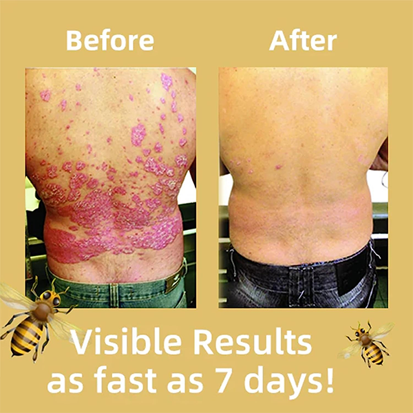 Gel de traitement du psoriasis au venin d'abeille de Nouvelle-Zélande Fivfivgo™