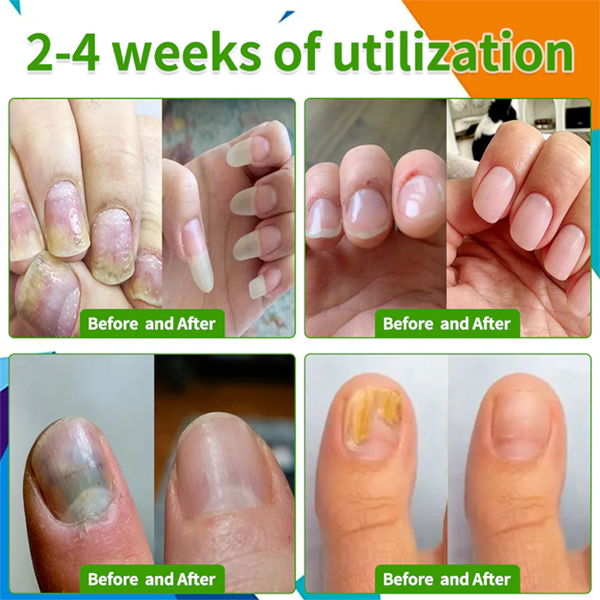 Fivfivgo™ BeeVenom FungiVanish-Behandlungsspray👨‍⚕️ (Fördert die Nagelregeneration, beseitigt wirksam Nagelpilz, Fußpilz und Fußgeschwüre)