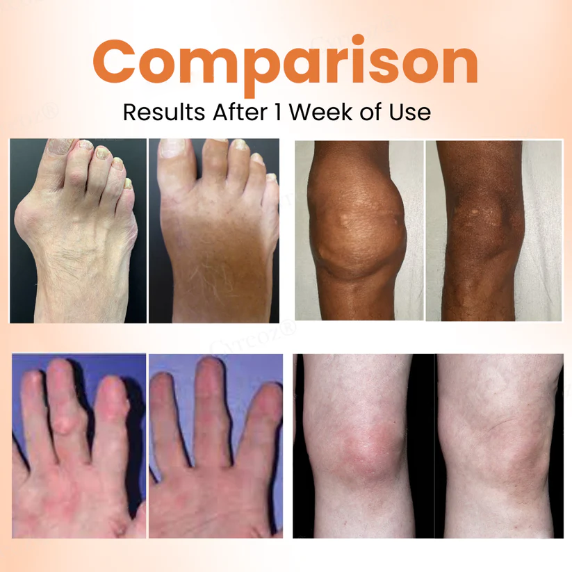 Fivfivgo® Colchicine Nano-Needles Patches for Gout Care
