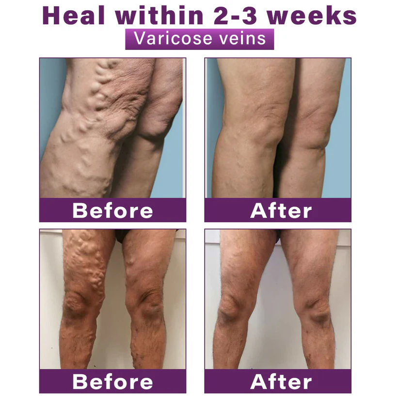 Cvreoz® Polidocanol Nano Varicose Vein Patch👩🏼‍⚕️Recommended by the National Institute for Health and Care Excellence (NICE)