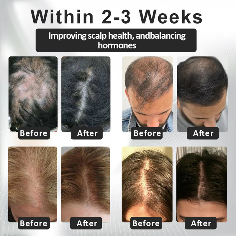 Fivfivgo™ Alopecia Recovery Hair Booster Roll-On