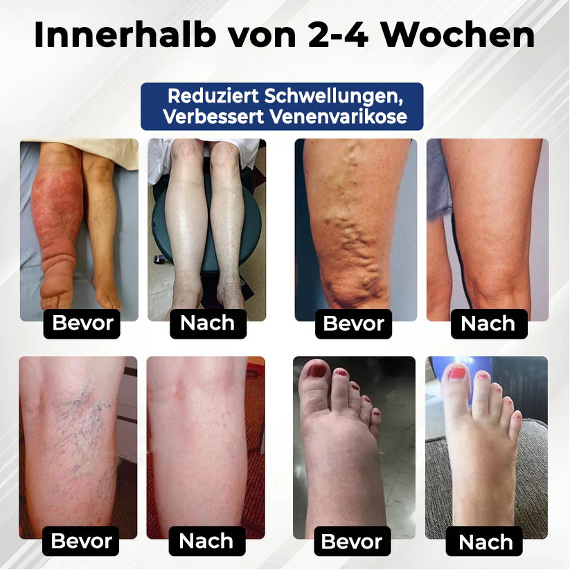 Fivfivgo® VenoHerb Schwarzkümmel-Ödemlöser-Balsam