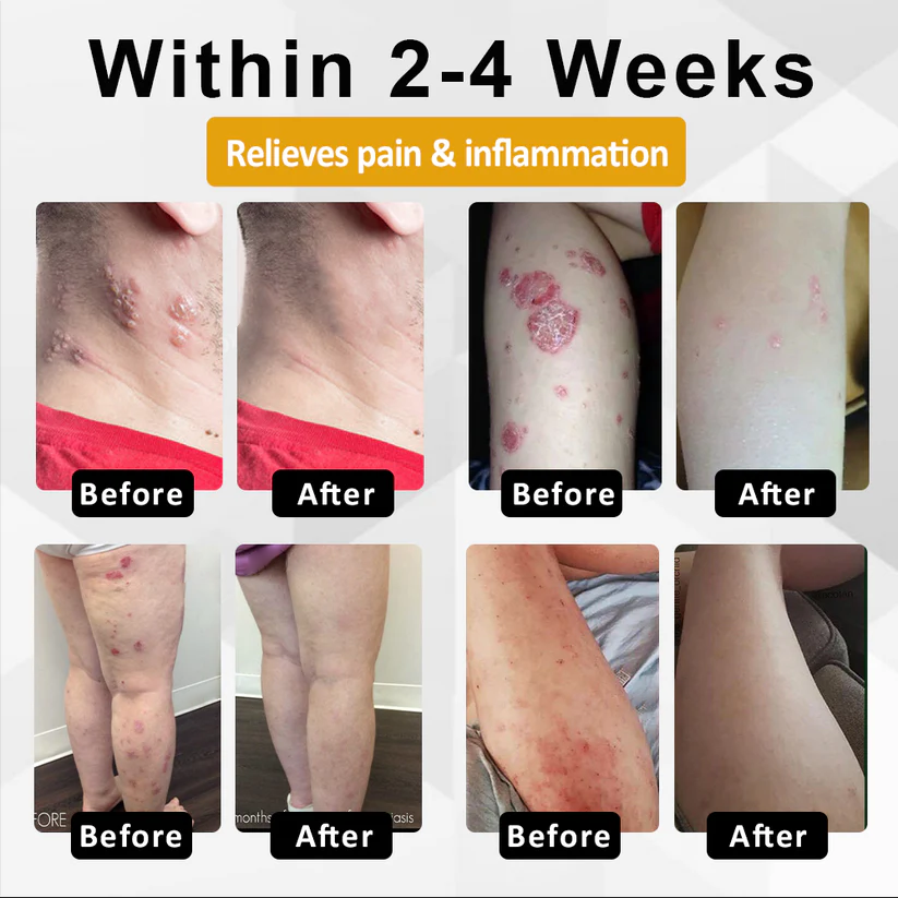 Fivfivgo® NervoRelief Shingles Healing Ointment