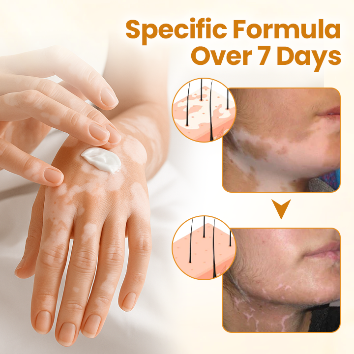 Oveallgo® VitiClear Pro Bee Venom Cream