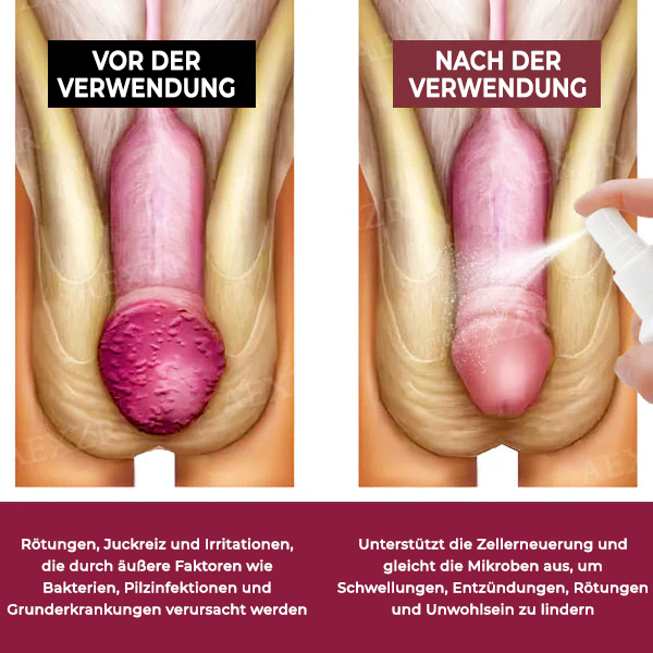 Fivfivgo® Balanitis Behandlungsspray
