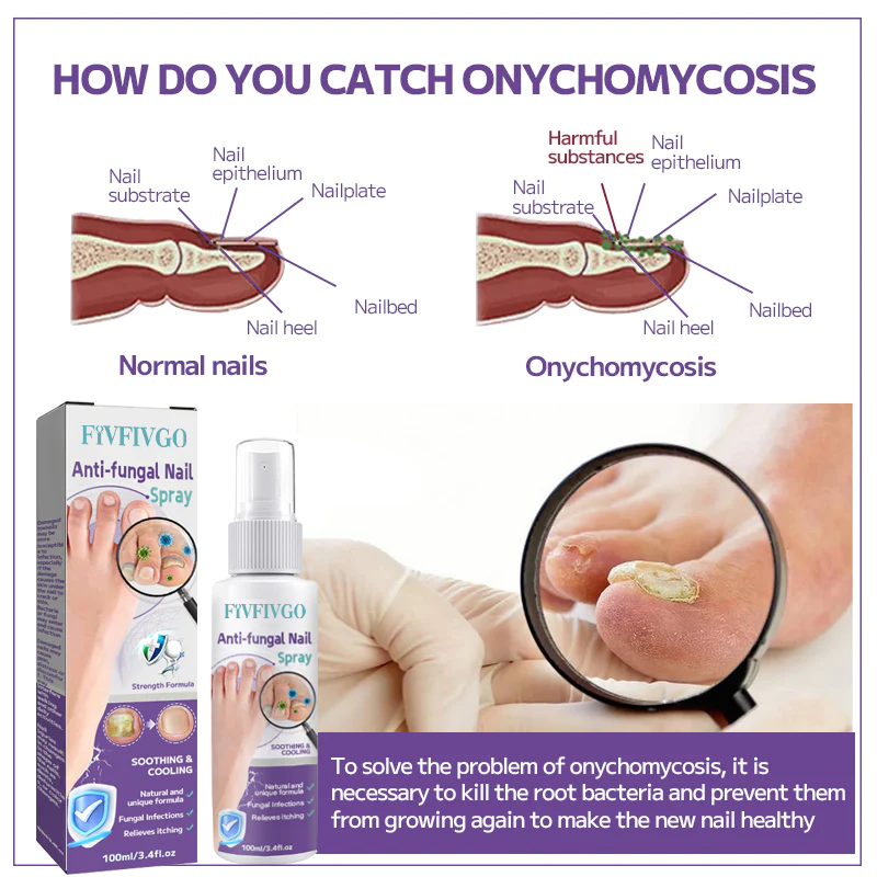Fivfivgo™ Anti-fungal Nail Spray
