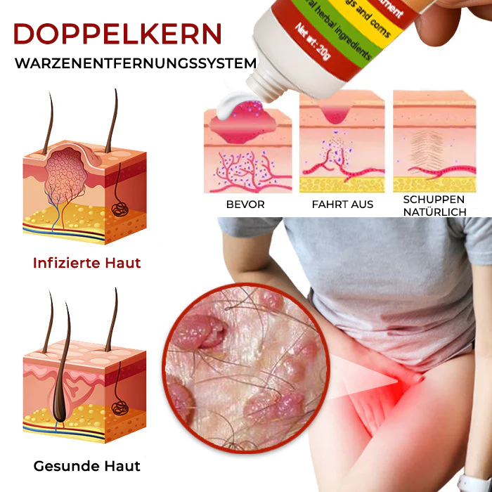 Cvreoz® FemGenital Warzenentferner Creme