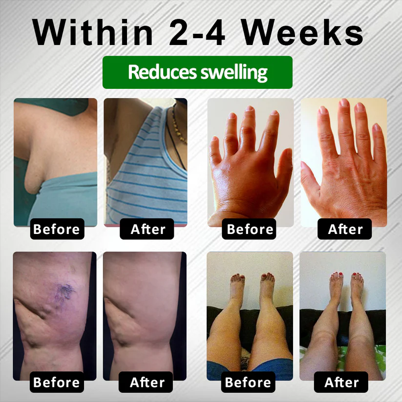 NovaRX® PuffyGone Horse Chestnut Edema Cream