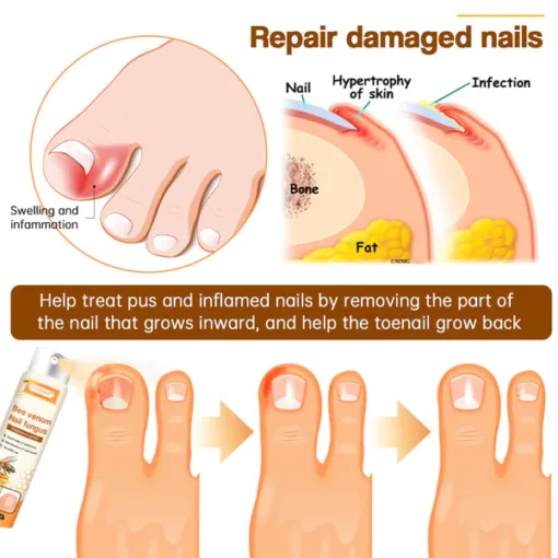 Fivfivgo™ Bee Venom Nail Fungus Treatment Spray