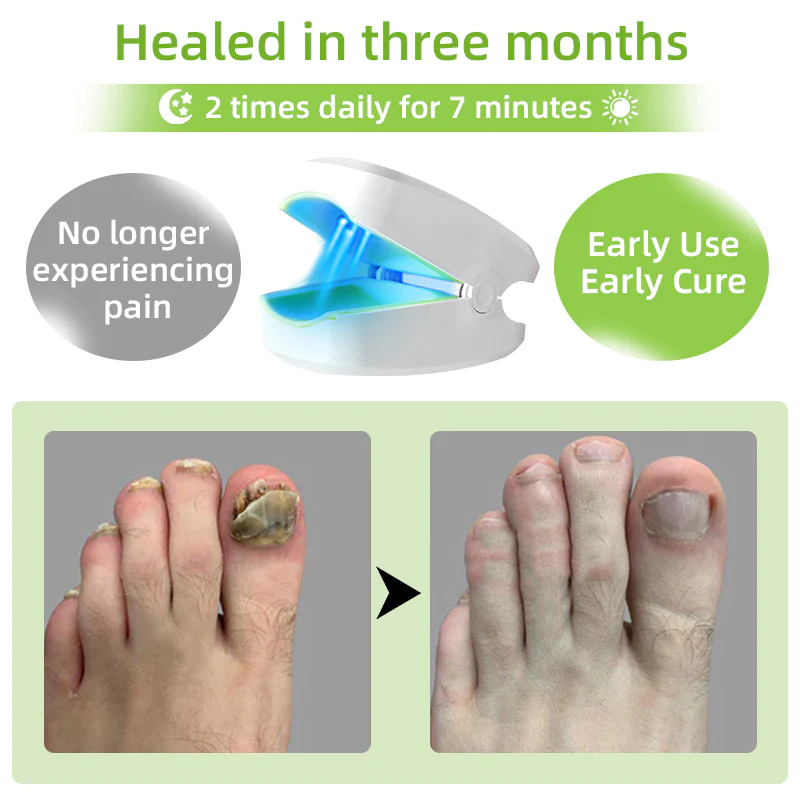 Fivfivgo™ Nagelpilz-Lasertherapiegerät Max