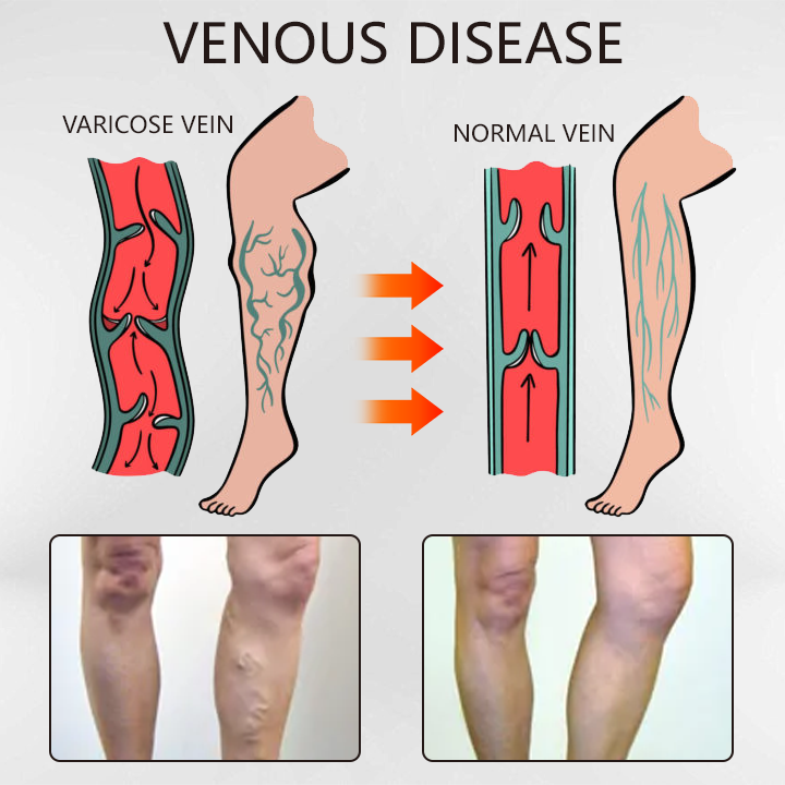 Fivfivgo™ Varicose Veins Relief Oil