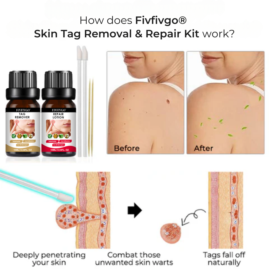Fivfivgo® Skin Tag Removal & Repair Kit