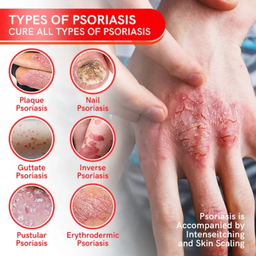 Fivfivgo™ Spray zur Behandlung von Bienengift-Psoriasis mit mehreren Symptomen