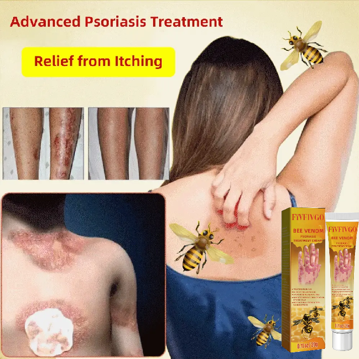 Fivfivgo™ Bee Venom Psoriasis Treatment Cream