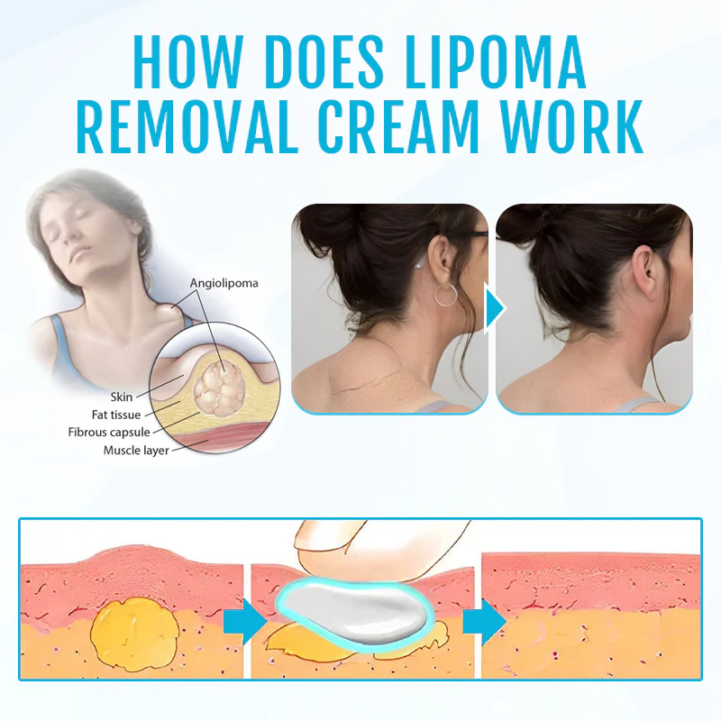 Fivfivgo™ LumpClear Lipom Entlastungscreme