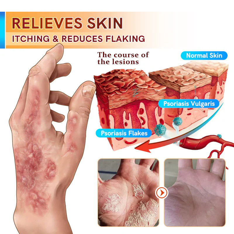 Fivfivgo™ Psoriasis Treatment Cream