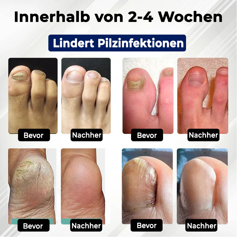 Fivfivgo® Fungiclear Bienen Therapie Nagelspray